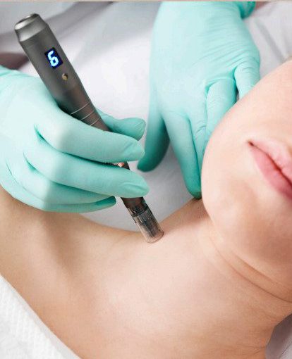 Microneedling behandeling voor betere opname van actieve stoffen in de huid ten behoeve van huidverjonging en huidverbetering bij huidproblemen