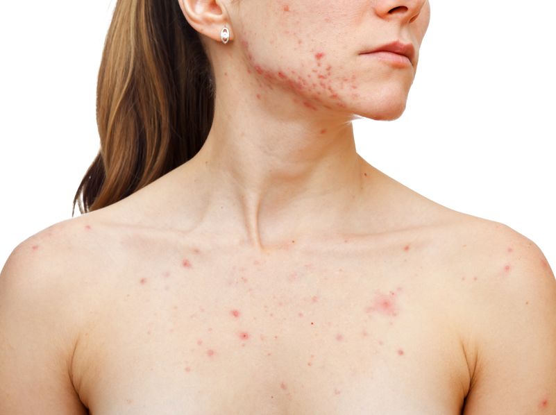 Acne behandeling bij huidproblemen, ontstekingen en puisten op je gezicht, borst of rug. Boek een consult in onze kliniek voor huidtherapie