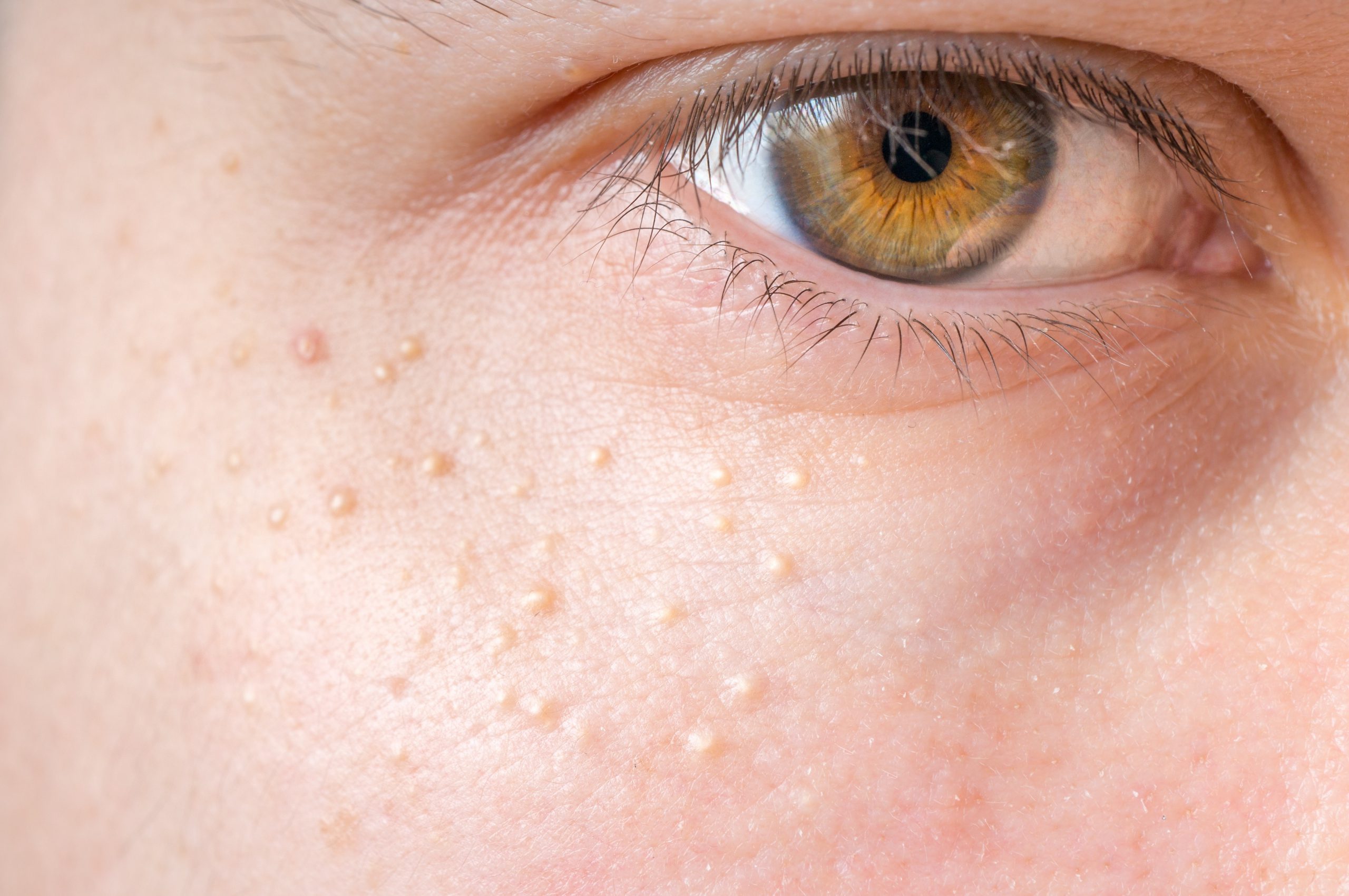 Last van milia of gerstekorrels rond jouw ogen? Door laserbehandeling kan de huidtherapeut in onze huidkliniek ze gemakkelijk verwijderen