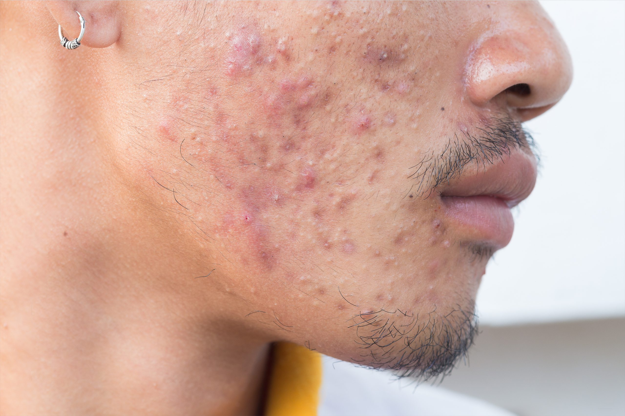 Acne, puisten en ontstekingen op de wang van een jonge man, kunnen behandeld door de huidtherapeut door middel van een acnebehandeling