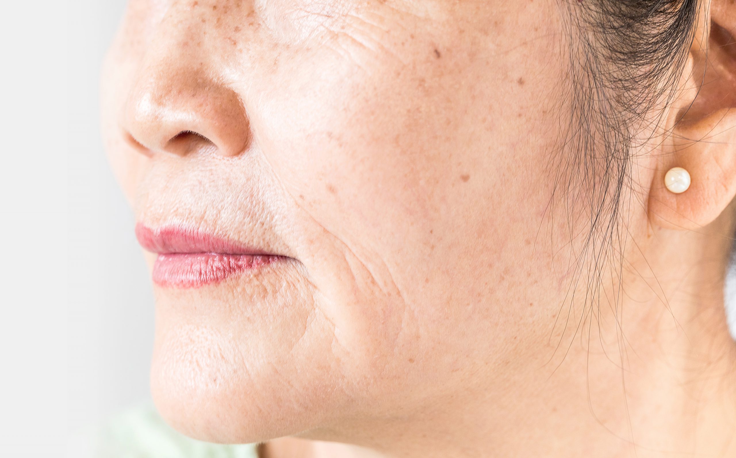 Dame met slapper wordende huid en rimpels boekt consult bij de huidkliniek voor laserbehandeling voor huidverjonging