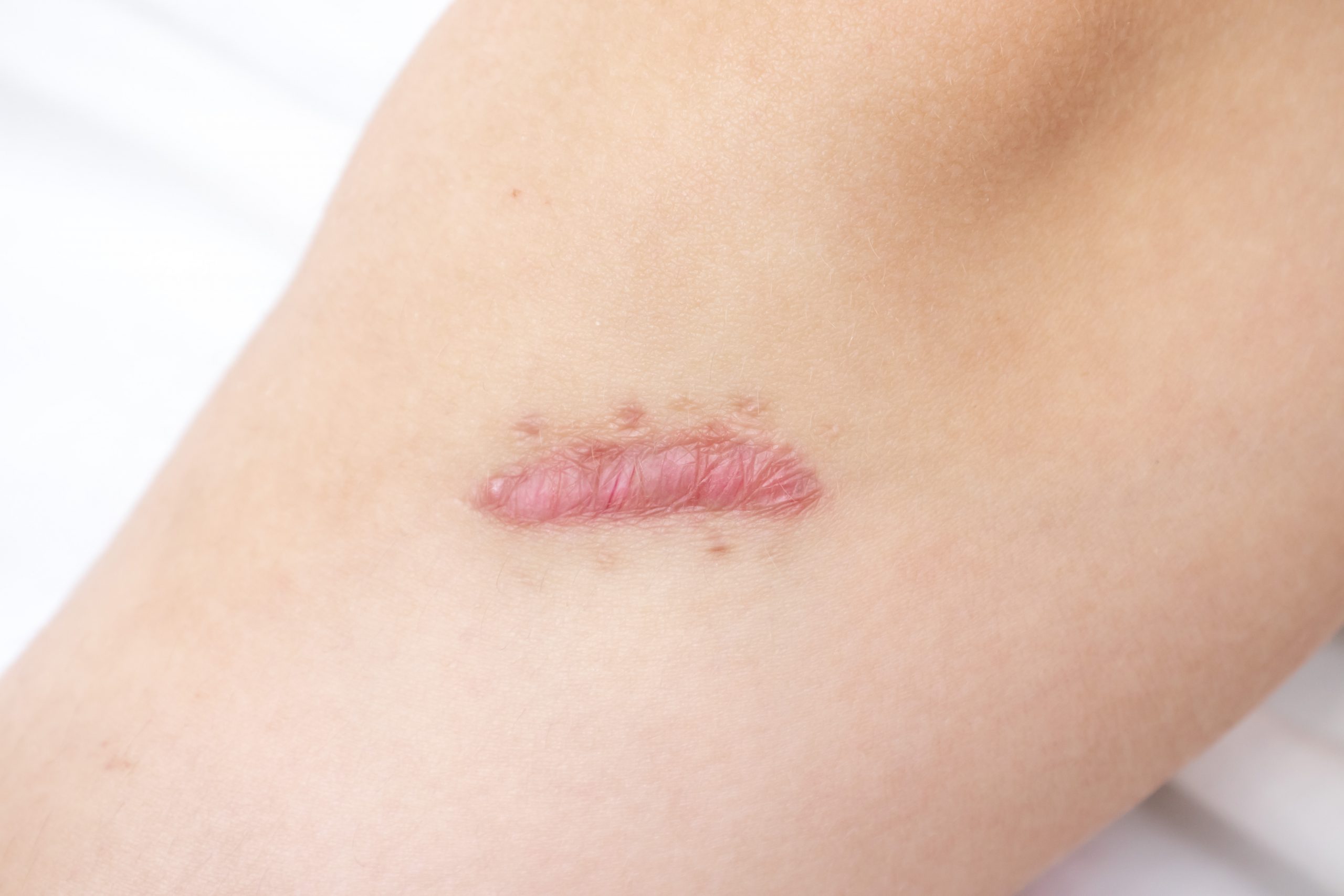 Atrofisch litteken op huid kan behandeld worden door middel van laserbehandeling in onze huidkliniek