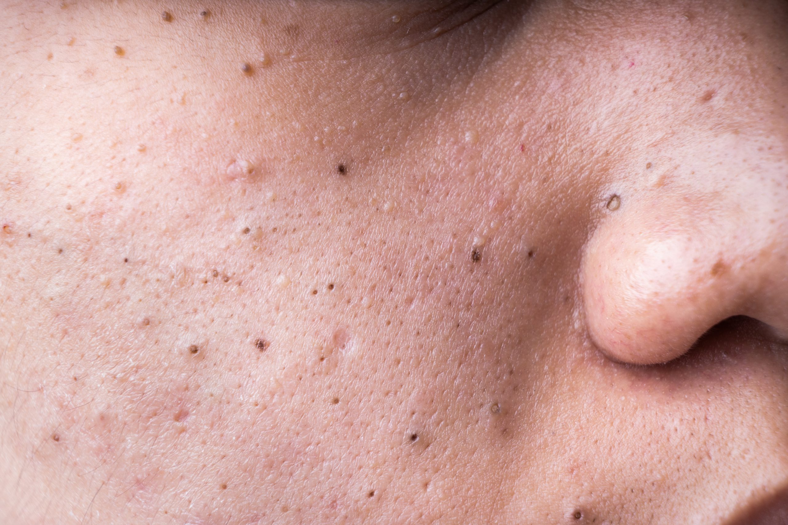 Op zoek naar een acne behandeling voor huidverbetering van jeugdpuistjes en mee-eters?