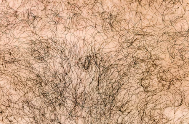 Last van overbeharing? Borsthaar, rughaar of okselhaar bij mannen kunnen verminderd worden door middel van laserontharing in onze huidkliniek
