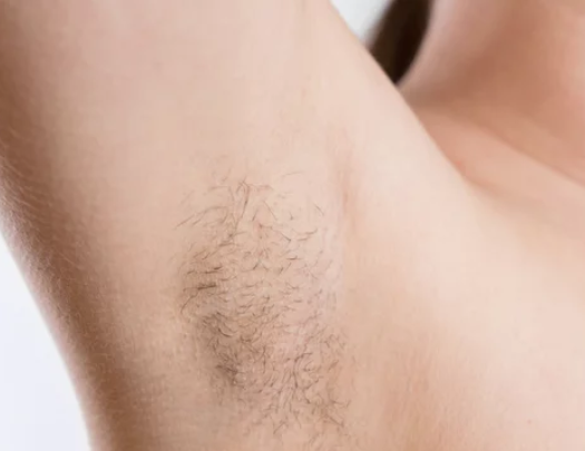 Okselhaar bij dame kan verminderd worden door middel van permanente laserontharing bij de huidtherapeut