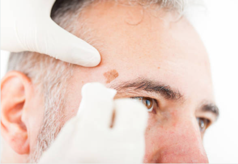 Last van een donkere pigmentvlek in je gezicht of je lichaam als het gevolg van zonneschade? Wij behandelen pigmentvlekken door middel van laserbehandeling en peeling voor huidverbetering