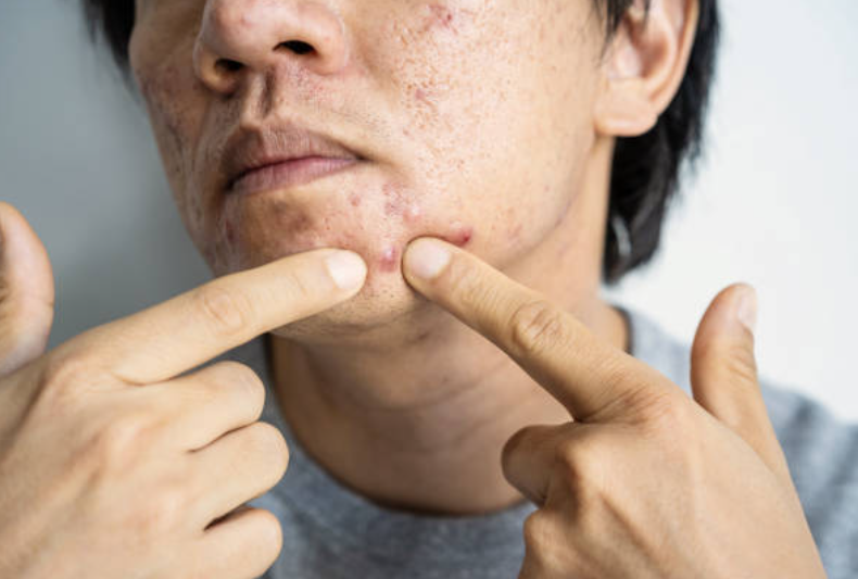 Last van acne, ontstekingen of jeugdpuistjes? Voorkom krabben en uitknijpen, maar vraag om advies en een acne behandeling van onze huidtherapeut in Dordrecht