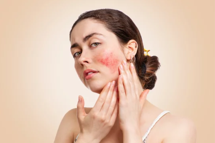 Vrouw heeft last van couperose, roodheid en rosacea op de huid die de huidtherapeut uit regio Dordrecht kan behandelen met laserbehandeling