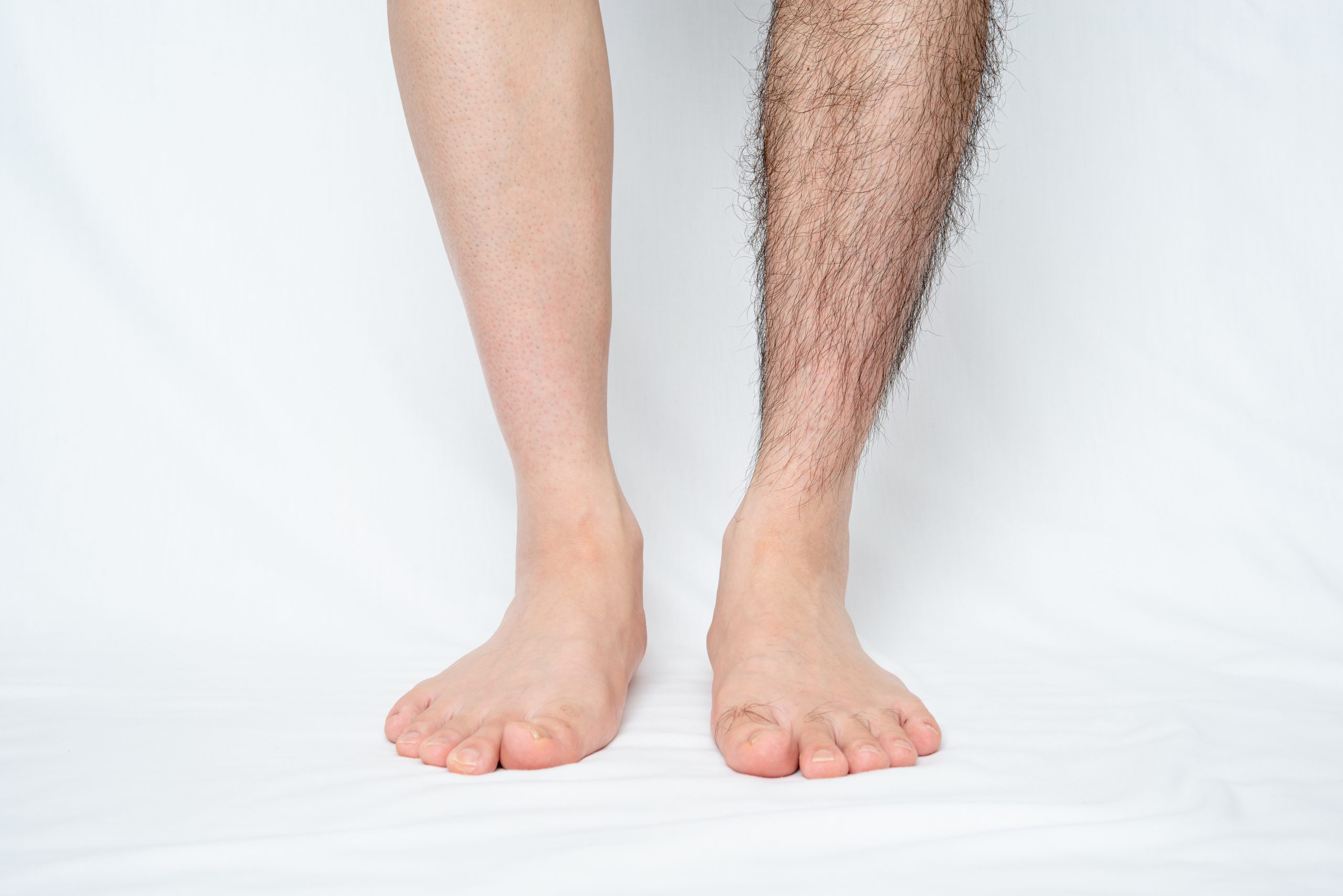 Laserontharing bij de huidtherapeut: Permanente ontharing van o.a. benen, armen, oksels, nek en bikinilijn