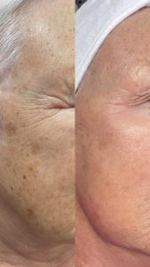 Voor en na foto van de behandeling van huidverbetering bij pigmentvlekken in het gezicht