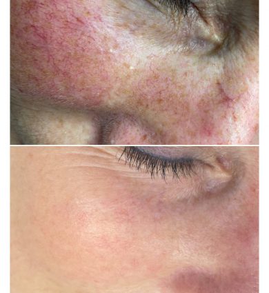 Voor en na foto van behandeling voor couperose en vasculaire rosacea, bij de huidtherapeut in Dordrecht